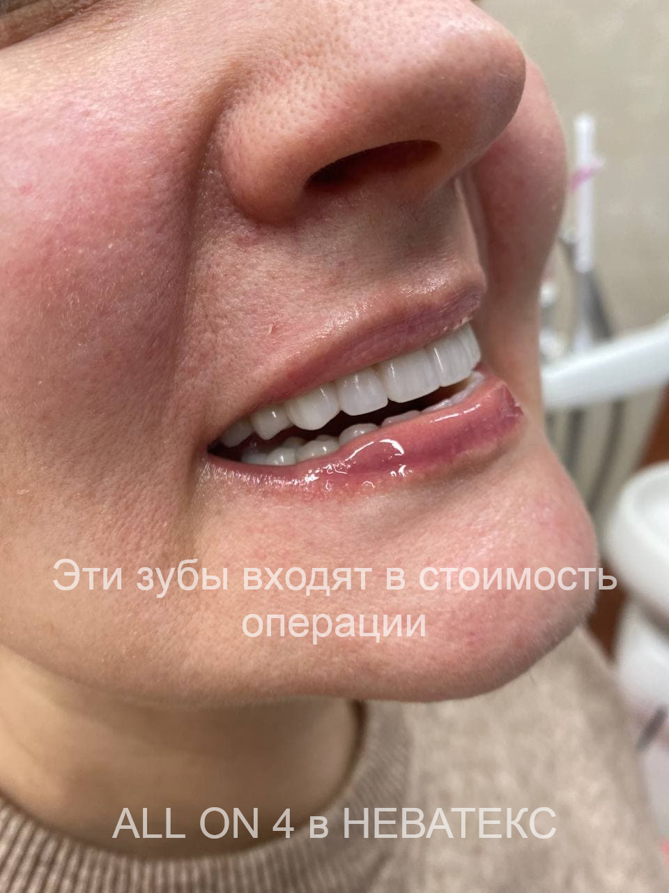 пациент после операции all-on-4 пациент после операции all-on-4